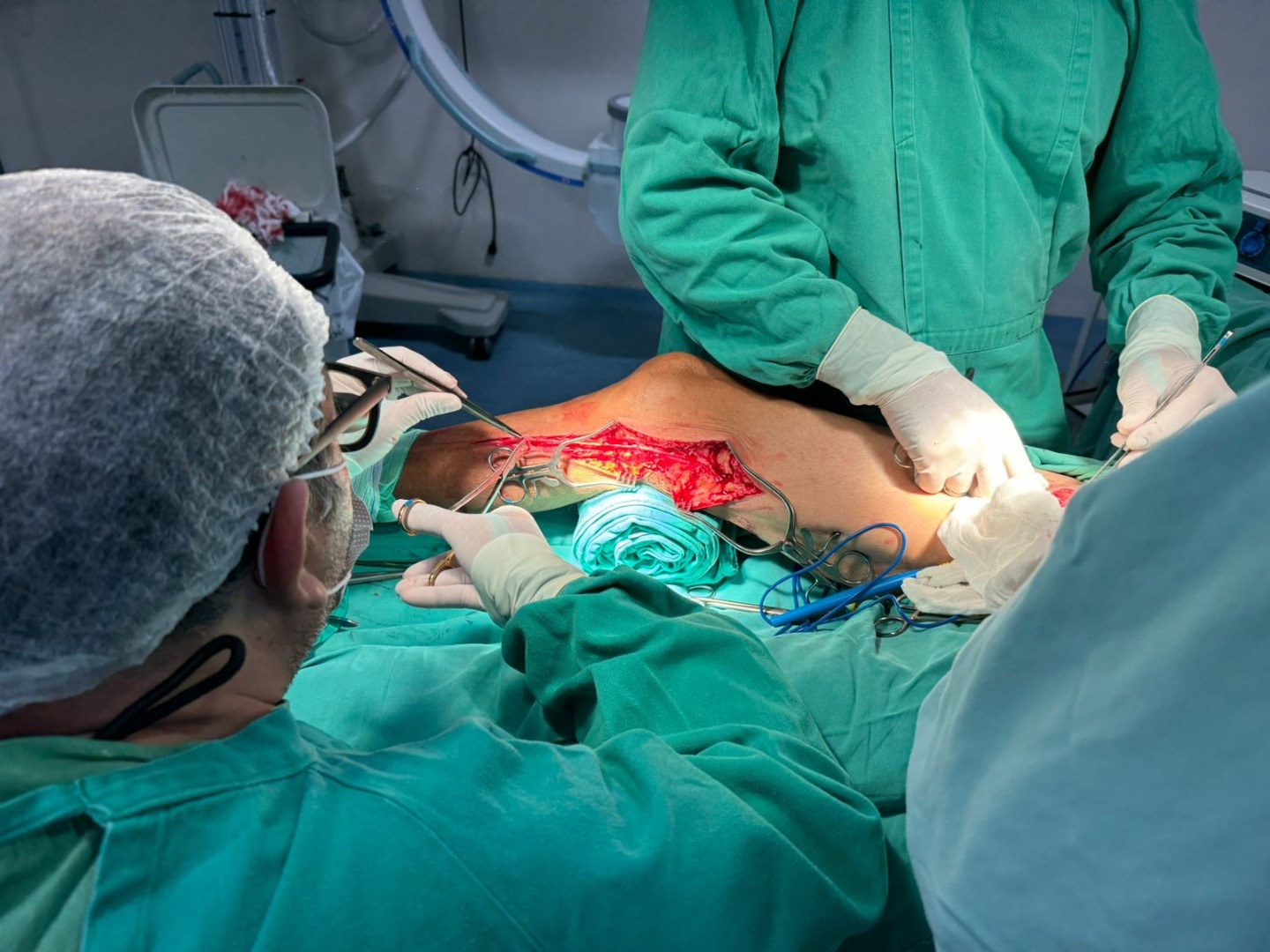 A cirurgia de ByPass foi realizada pela primeira vez no Hospital de Patos.jpg