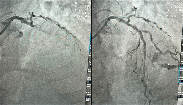 Coração Paraibano_ Hemodinâmica do Regional de Patos é palco da primeira angioplastia coronariana do sertão paraibano 4.JPG