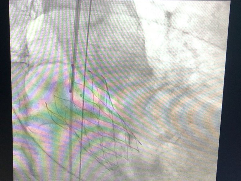 Hemodinâmica do Hospital Metropolitano realiza primeiro implante transcateter de válvula aórtica de 2024 2.jpeg