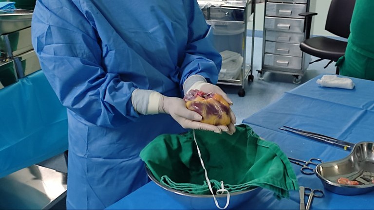 Primeiro transplante de coração de 2023 na Paraíba é realizado no Hospital Metropolitano_3.jpeg