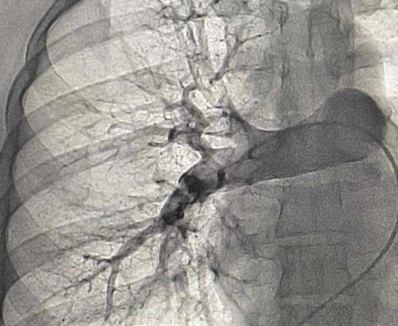 Recurso de alta complexidade Trombectomia mecânica salvou a vida de sertanejos na Hemodinâmica de Patos (02).jpeg