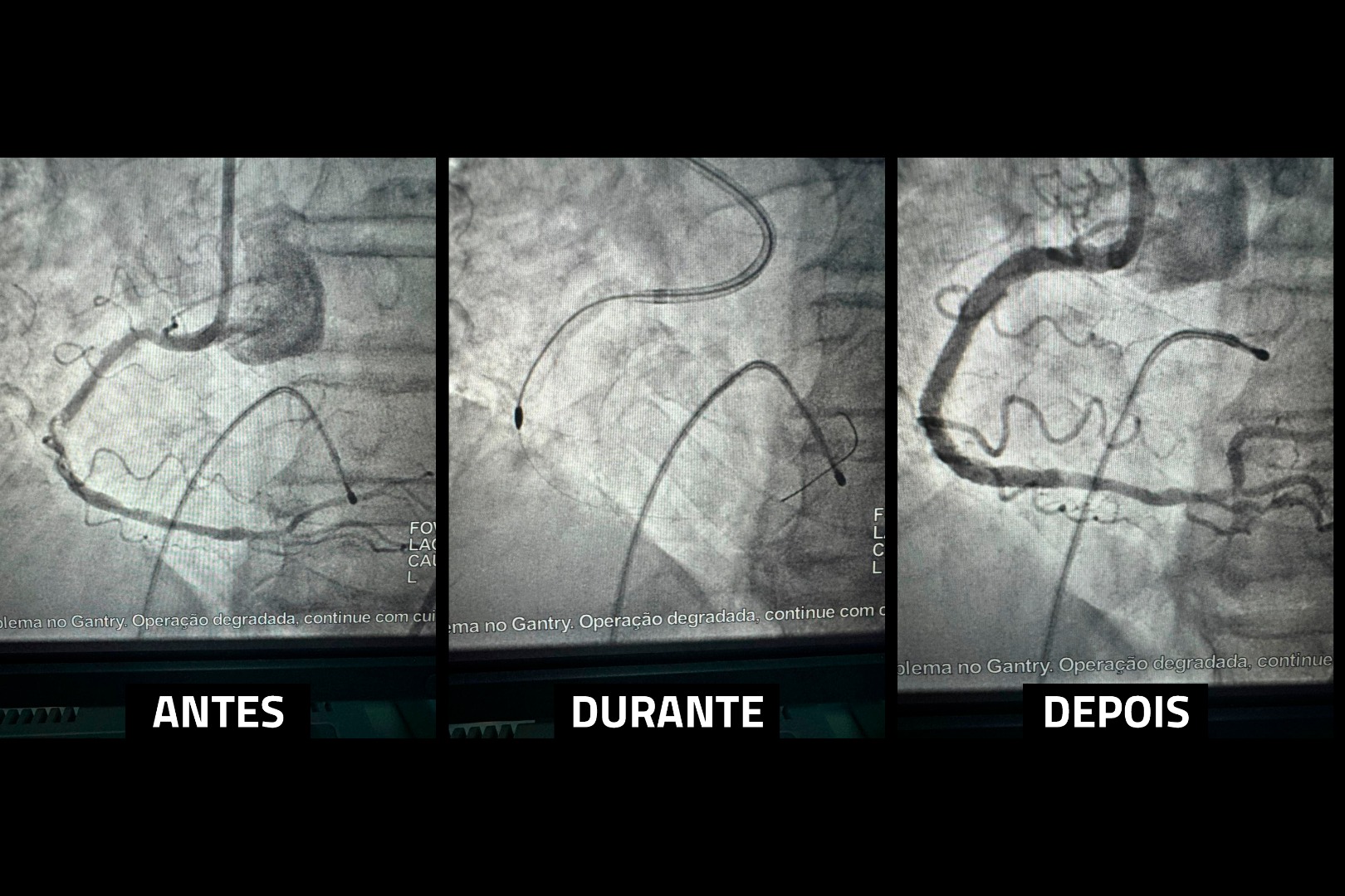 Angioplastia com Aterectomia Rotacional procedimento inédito no Metropolitano salva paciente idoso 2.jpg