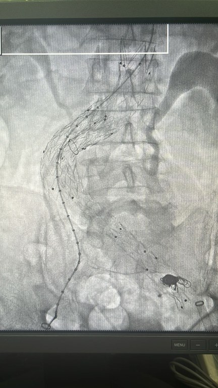 Serviço de Hemodinâmica gerenciado pela PB Saúde realiza procedimento inédito para tratamento de aneurisma raro  1.jpeg